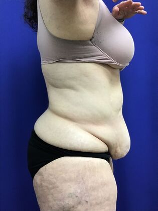 Body Tummy Tuck / Abdominoplasty: Case 25 (2905148) - Before, prominent overlap and looseness