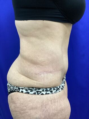 Body Tummy Tuck / Abdominoplasty: Case 25 (2905148) - After, nearly flat contour of her tummy