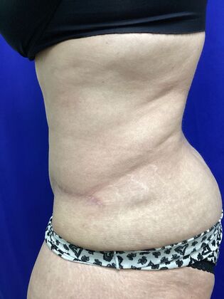 Body Tummy Tuck / Abdominoplasty: Case 25 (2905148) - After