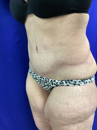 Body Tummy Tuck / Abdominoplasty: Case 25 (2905148) - After