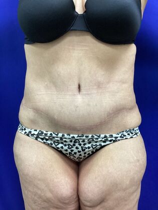 Body Tummy Tuck / Abdominoplasty Case 25 (2905148) - After