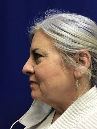 Facial Facelift / Necklift: Case 26 (994446) - Before