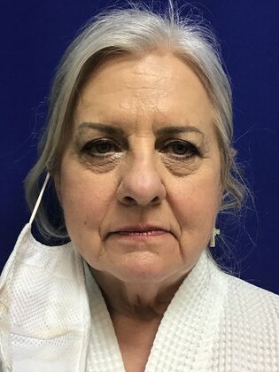 Facial Facelift / Necklift Case 26 (994446) - Before