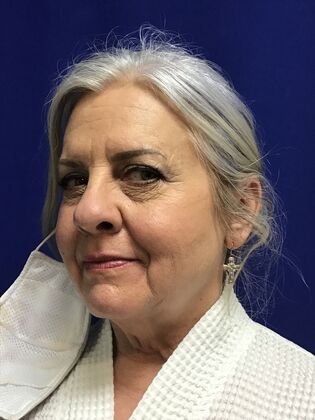 Facial Facelift / Necklift: Case 26 (994446) - Before