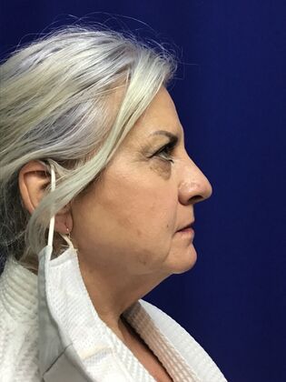 Facial Eyelid Surgery / Blepharoplasty: Case 13 (994446) - Before