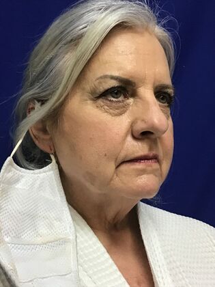 Facial Eyelid Surgery / Blepharoplasty Case 13 (994446) - Before