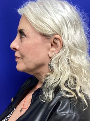 Facial Eyelid Surgery / Blepharoplasty: Case 13 (994446) - After