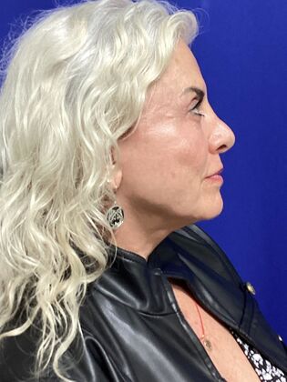 Facial Eyelid Surgery / Blepharoplasty: Case 13 (994446) - After