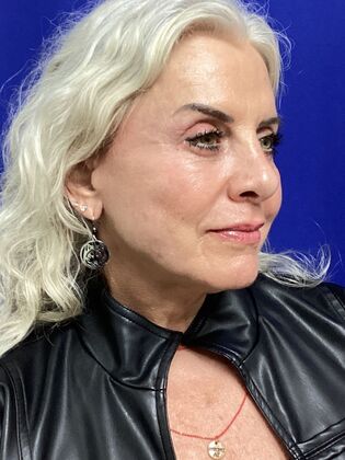 Facial Eyelid Surgery / Blepharoplasty Case 13 (994446) - After