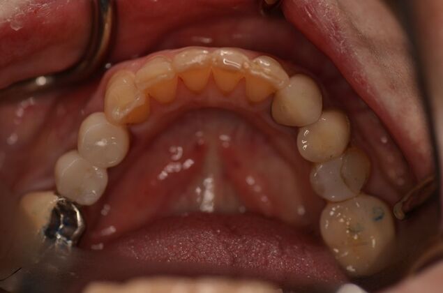 Dental Implants: Case 59 - After two implants and crowns