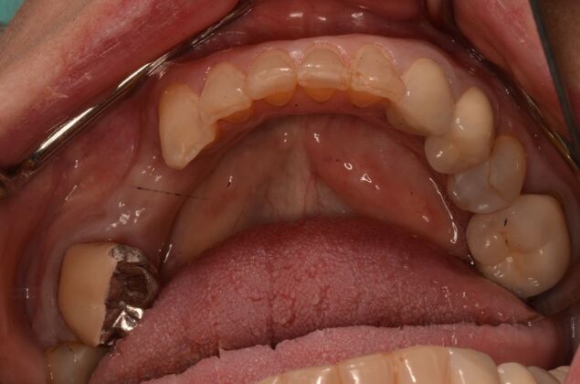 Dental Implants: Case 59 - Before dental implants