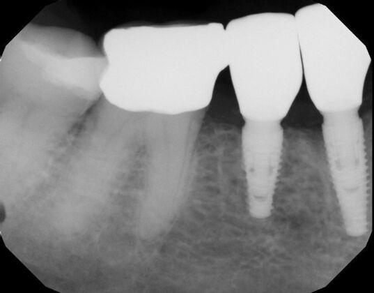 Dental Implants: Case 59 - After implants and crowns