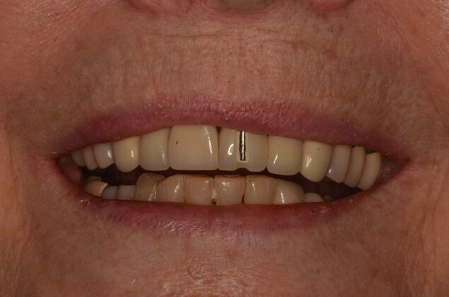 Bridges Case 10 - Before