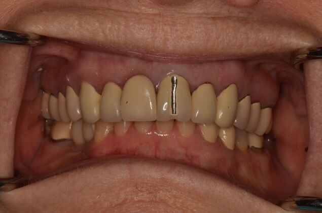 Bridges: Case 10 - Old Anterior bridge
