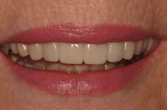 Bridges Case 10 - After