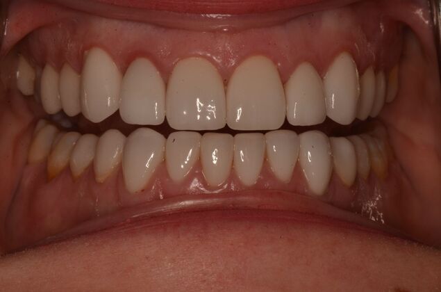 Porcelain Veneers: Case 32 - 17 year old Porcelain veneers