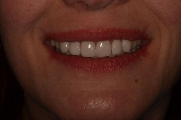 Porcelain Veneers: Case 32 - 17 year old Porcelain veneers