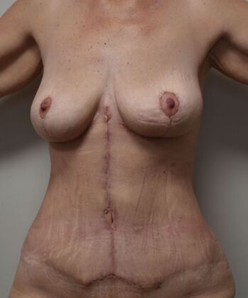 Massive Weight Loss : Case 120 - After