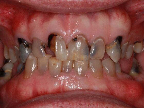 Before dental implants