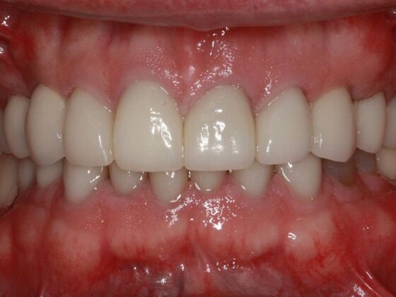 After dental implants