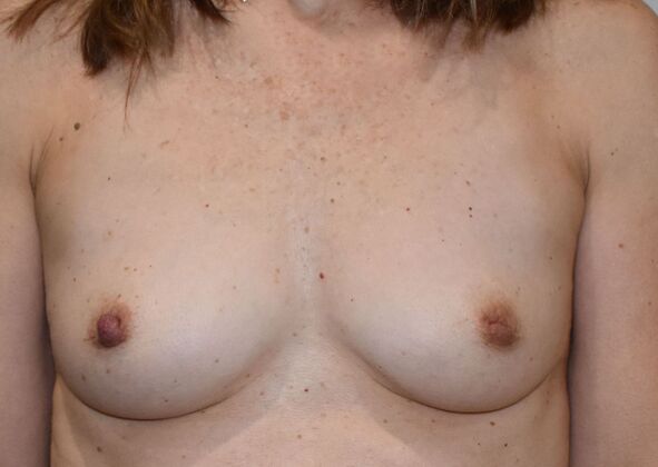 Breast Augmentation Case 721 - Before