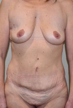Massive Weight Loss : Case 121 - Before