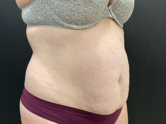 Emsculpt Neo Case 1 - Before