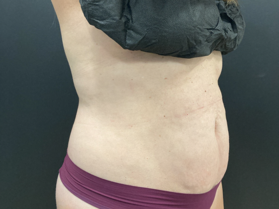 Emsculpt Neo Case 1 - After