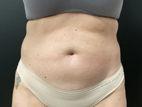 Emsculpt Neo Case 2 - Before