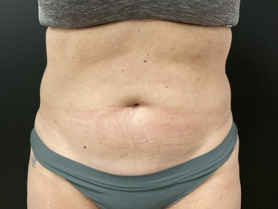 Emsculpt Neo Case 2 - After