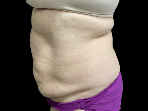 Emsculpt Neo Case 3 - Before