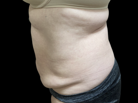 Emsculpt Neo Case 3 - After