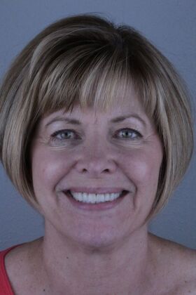 Before And After Case 3 - After