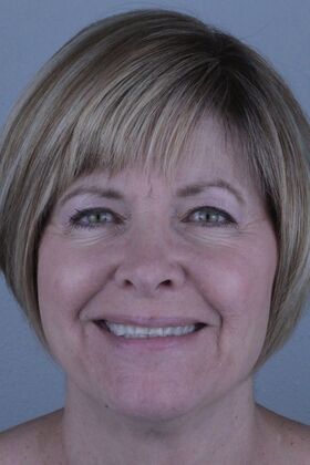 Before And After Case 3 - Before