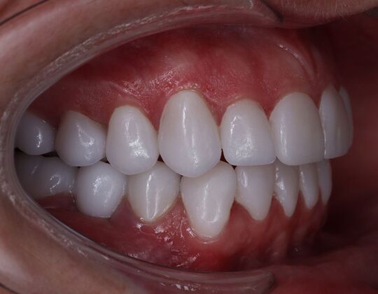 Porcelain Veneers: Michelle - After