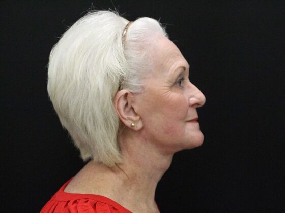 Face & Neck Lifts: Case 2 - After