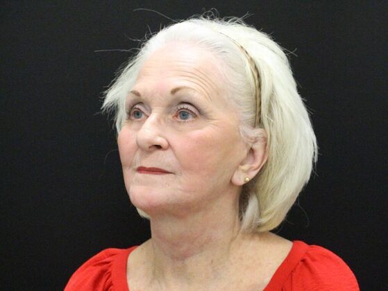 Face & Neck Lifts: Case 2 - After