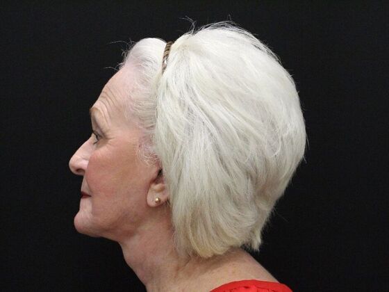 Face & Neck Lifts: Case 2 - After