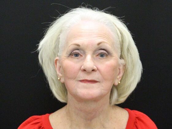 Face & Neck Lifts: Case 2 - After