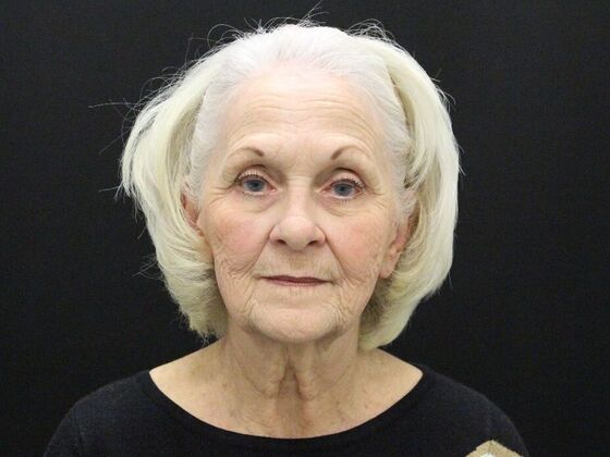 Face & Neck Lifts: Case 2 - Before