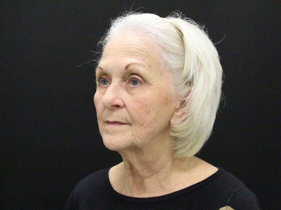 Face & Neck Lifts: Case 2 - Before