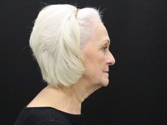 Face & Neck Lifts: Case 2 - Before