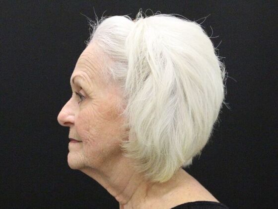 Face & Neck Lifts: Case 2 - Before