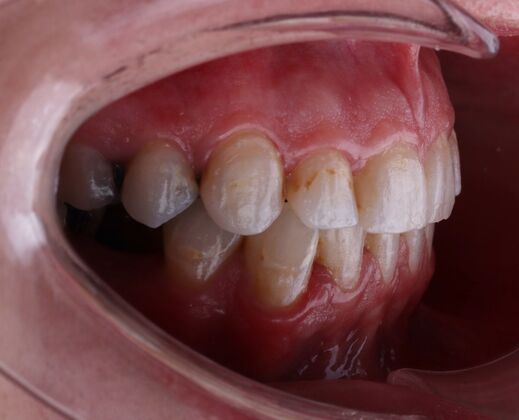 Porcelain Veneers: Michelle - Before