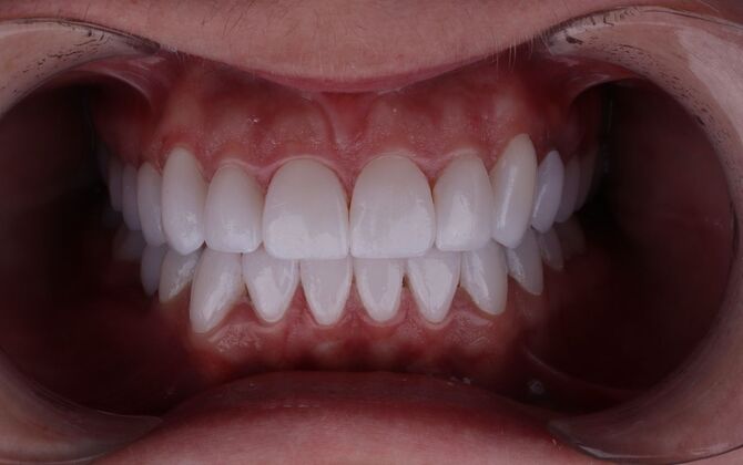 Porcelain Veneers: Michelle - After