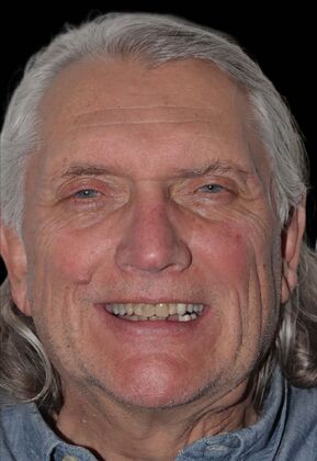 All-On-4/6: Paul H - Total Fixed Prosthesis - Peek Denture - Before