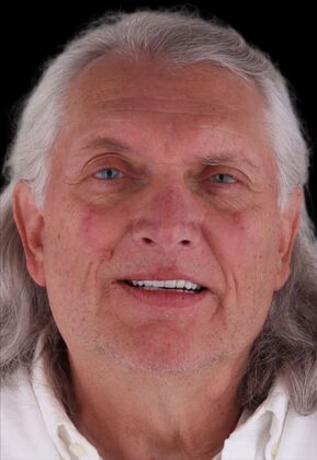 All-On-4/6: Paul H - Total Fixed Prosthesis - Peek Denture - After