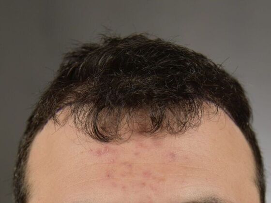 FUT Hair Restoration Case 4 - Before