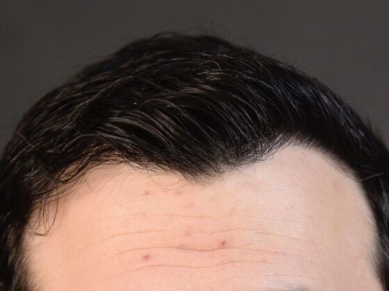 FUT Hair Restoration Case 4 - After