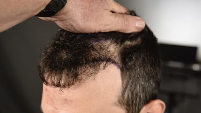 FUT Hair Restoration: Case 4 - Before